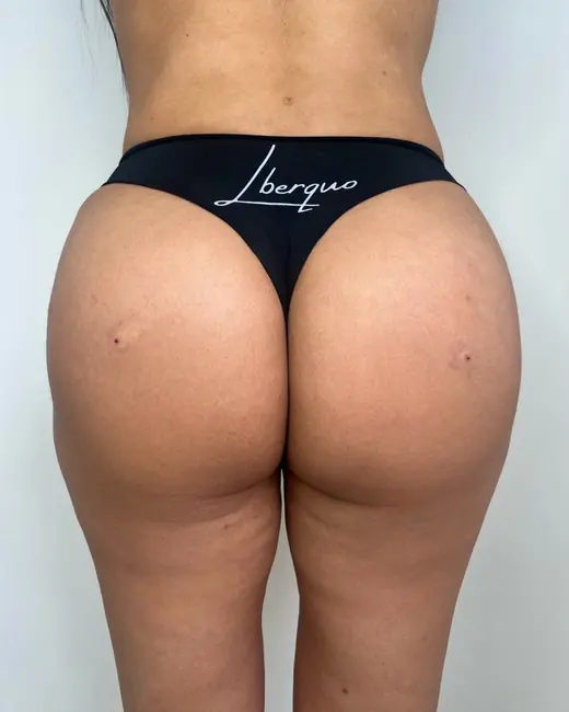 Resultado de harmonização glútea feita pela Larissa Berquó